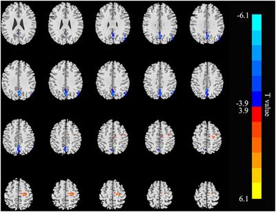 Altered Spontaneous Brain Activity and Functional Integration in Hemodialysis Patients With End-Stage Renal Disease
